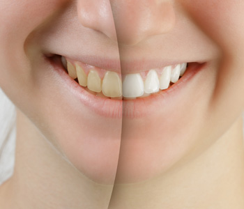 Teeth Whitening Before After