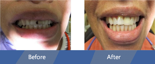 Dental Bonding Before and After Case 01