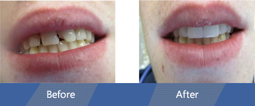 Dental Bonding Before and After Case 02