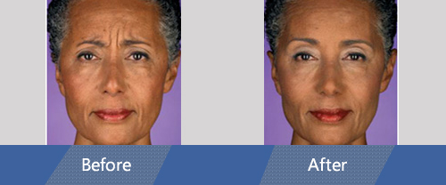Botox and Dermal Fillers Before and After Case 04