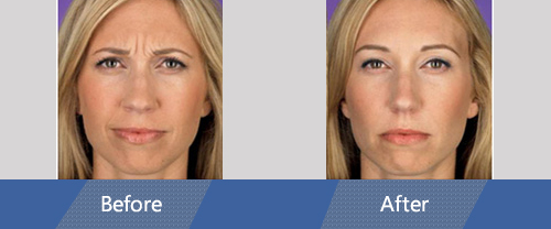 Botox and Dermal Fillers Before and After Case 05