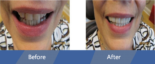 Snap On Smile Before and After Case 01