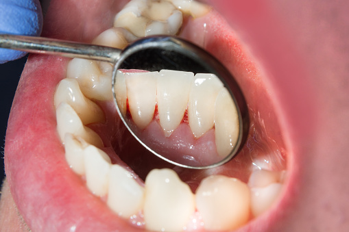 Plaque of the patient, stone. Dentistry treatment of dental plaque, professional oral hygiene. The concept of harm to smoking and cleaning teeth