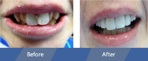 Cosmetic Veneers Before and After Case 02