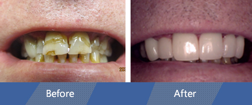 Cosmetic Veneers and Dental Crowns Before and After Case 03