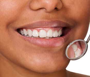 Porcelain Veneers