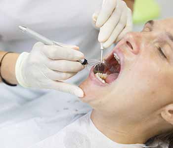 Professional cleaning removes dental plaque for healthy San Francisco smiles