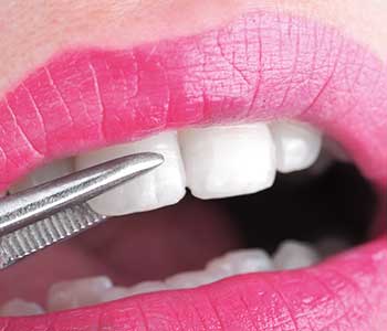 Advantages of porcelain dental veneers in Daly City, CA