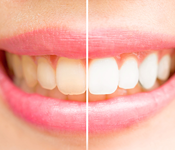 What Is Involved With Teeth Whitening?