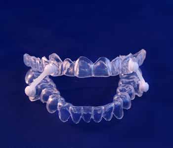 Image of a Oral Appliance