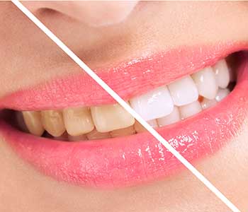 Best Teeth Whitening techniques - San Francisco, CA