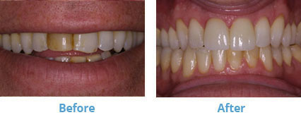 Veneers San Francisco - bleaching (BriteSmile®) to brighten Before & After