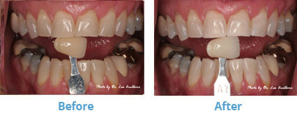 Dentist San Francisco - Before and After Image 01