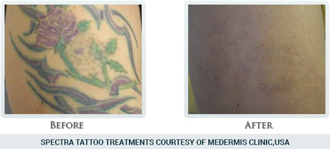 Tattoo Removal Before and After 10