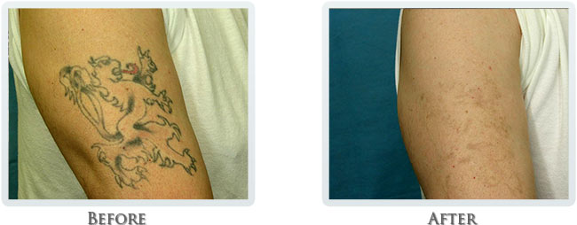 Tattoo Removal Before and After 02
