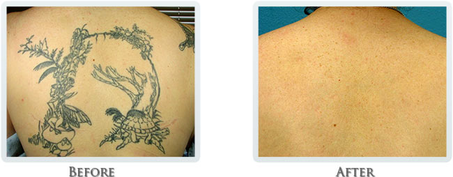 Tattoo Removal Before and After 03