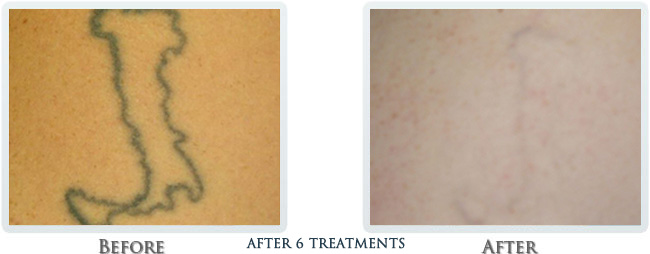 Tattoo Removal Before and After 05