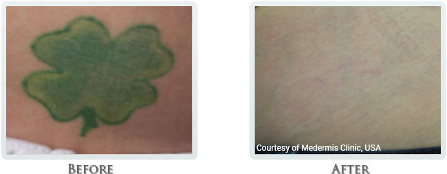 Tattoo Removal Before and After 06