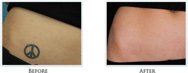 Tattoo Removal Before and After 08