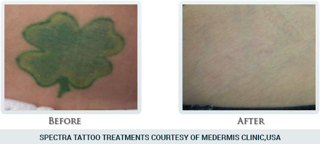 Tattoo Removal Before and After 09