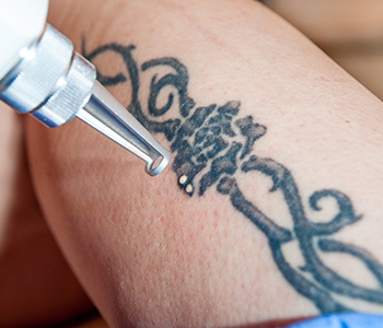 Portland, OR physician offers recommendations for effective tattoo removal