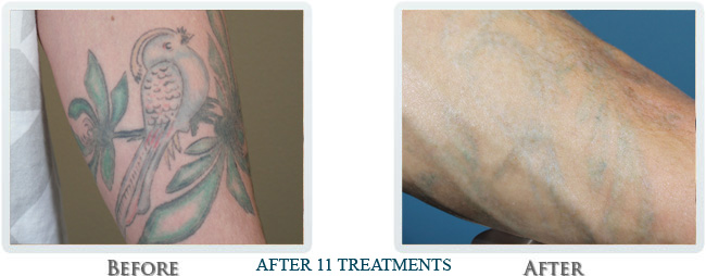 Tattoo Removal Before and After 11