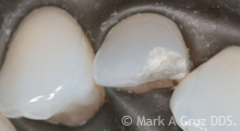 <?php echo $pk;?> - Chipped tooth isolated