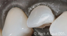 <?php echo $pk;?> - Preparation of chipped tooth for bonding
