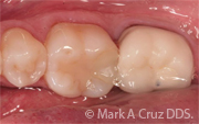 <?php echo $pk;?> - Tooth Colored