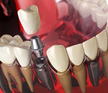 Can implants for replacement of teeth get infected? Ask a dentist in Quincy, MA