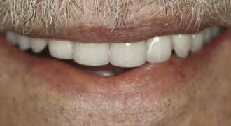 Implant Dentistry Procedure, Quincy
