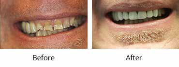 Implant Dentistry Before and After Image - 021