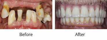 Implant Dentistry Before and After Image - 04