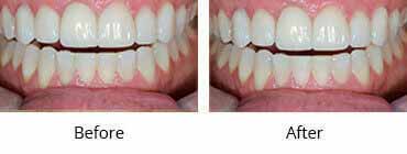 Full Denture Before and After Image - 07
