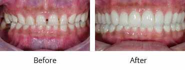 Smile Make Over Before and After Image - 11