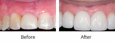 Smile Make Over Before and After Image - 13