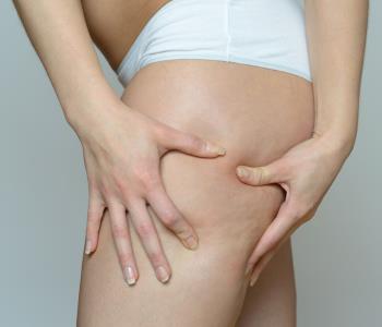 cellulaze laser treatmen from dermatologist in mountain view