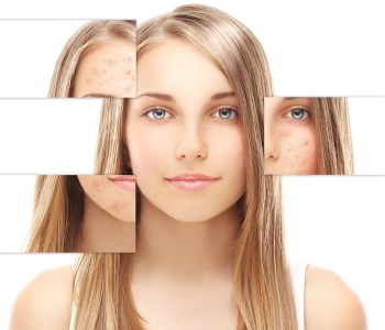 acne scar removal laser therapy from dermatological practice in Mountain View