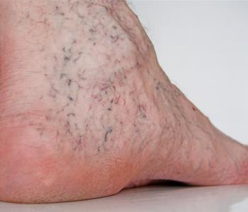 Spider Vein Treatment from dermatologists in Mountain View CA
