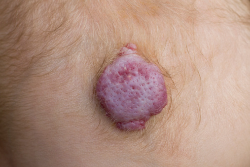 Dr Menkes Andrew at The Menkes Clinic & Surgery Center, Hemangiomas