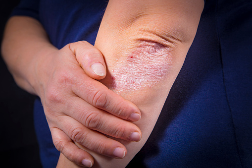 Dr Menkes Andrew at The Menkes Clinic & Surgery Center, Psoriasis