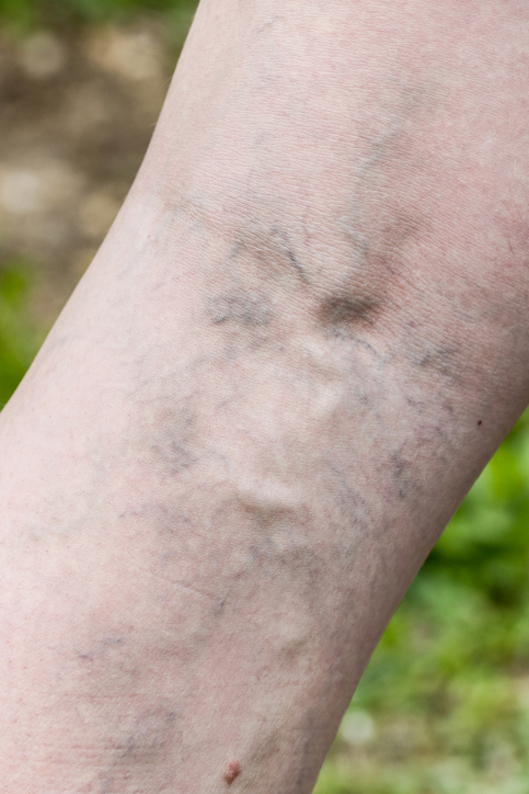 Dr Menkes Andrew at The Menkes Clinic & Surgery Center, Sclerotherapy