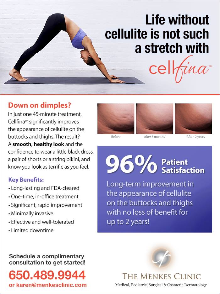 Life without cellulite can be a day at the beach with cellfina Menkes Clinic Cellfina Card