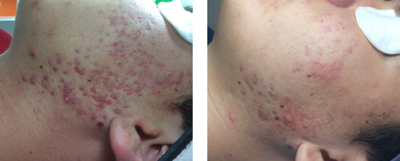 Fraxel Restore Mountain View - Before and After Image 01