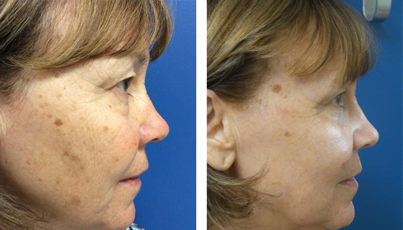 Before And After Photos Mountain View - Laser Resurfacing Image 16