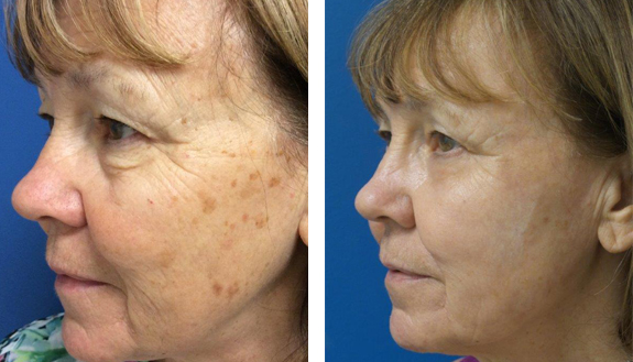 Before And After Photos Mountain View - Laser Resurfacing Image 17