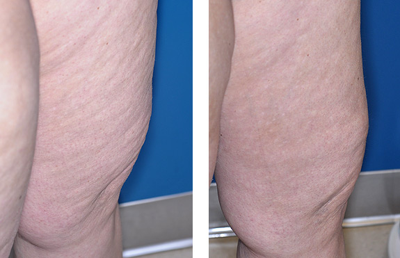 Before And After Photos Mountain View - Cellulaze Image 01
