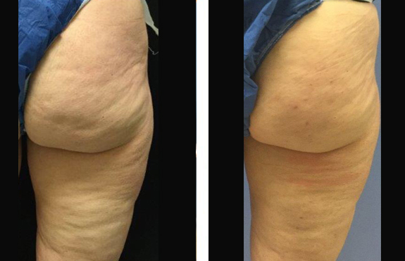 Before And After Photos Mountain View - Cellulaze Image 03