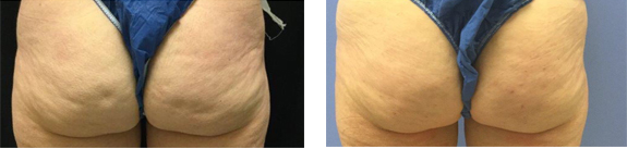 Before And After Photos Mountain View - Cellulaze Image 04