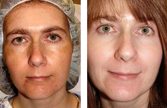 Before And After Photos Mountain View - Chemical Peels Image 01